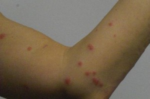 Scabies Symptons