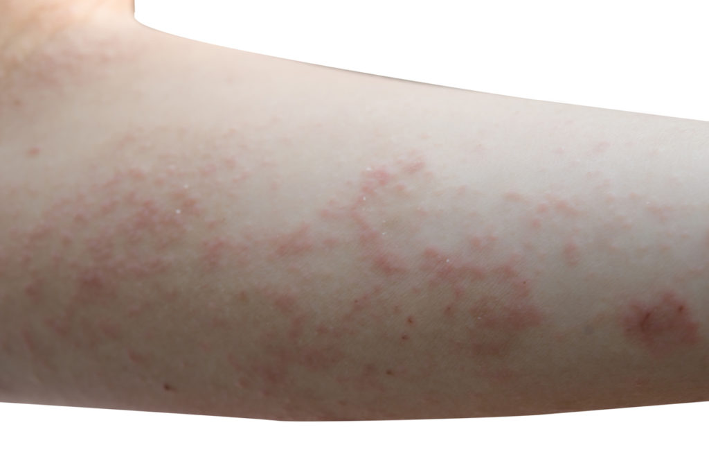 Itching And Rash After Scabies Treatment at Jean Humphrey blog