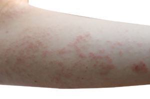 Human Itch Mite Rash